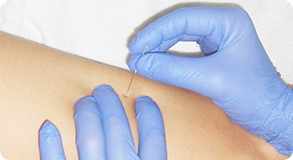 Pontos Gatilho, Agulhamento Seco (dry needling) e Dor Miofascial